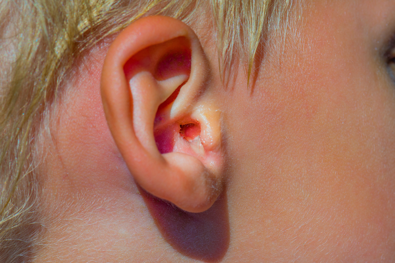 Immagine ravvicinata di orecchio di un bambino con mastoidite
